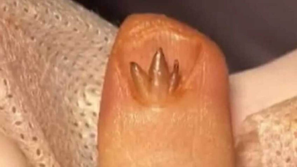 美甲突发问题,医生建议切除增生组织