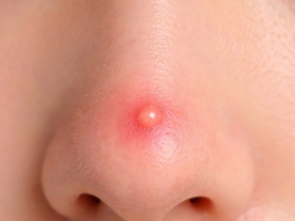 鼻子痘痘感染致命